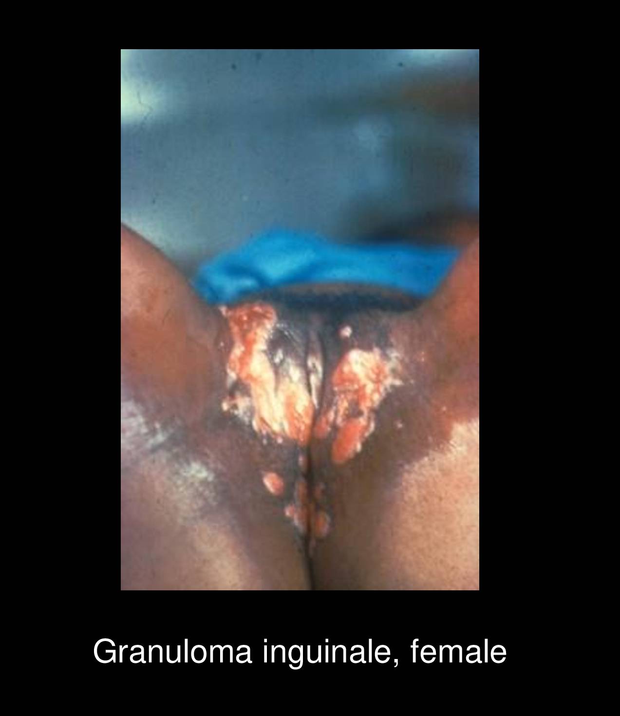 Donovanosis ulcerative lesion with rolled raised edges and granulating base showing painless character typical of granuloma inguinale infection